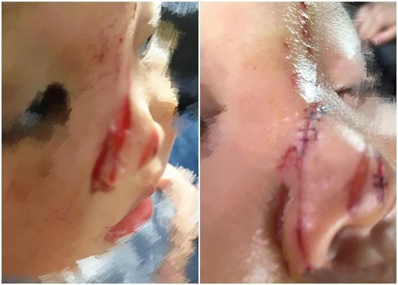 航拍保｜天降横祸！5岁女童被无人机划伤，脸部缝合21针或将毁容！