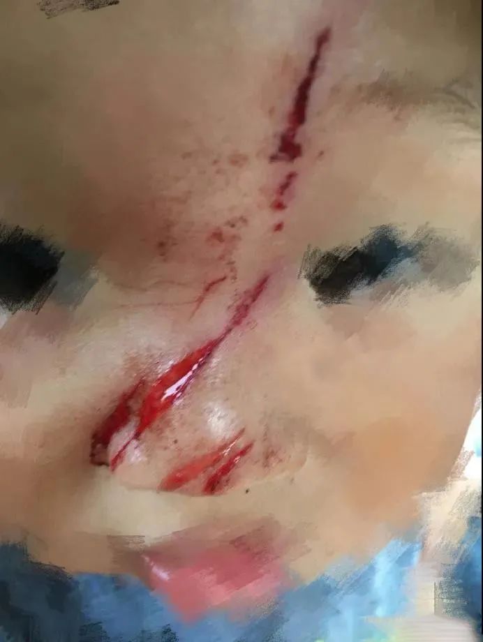 航拍保｜天降横祸！5岁女童被无人机划伤，脸部缝合21针或将毁容！